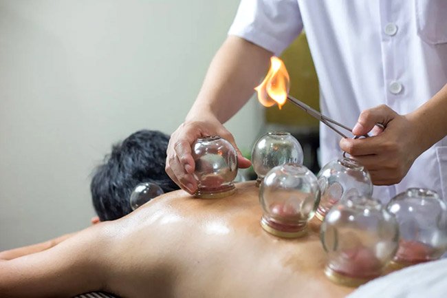 Cupping therapy treatment at The ON Acupuncture in Perth