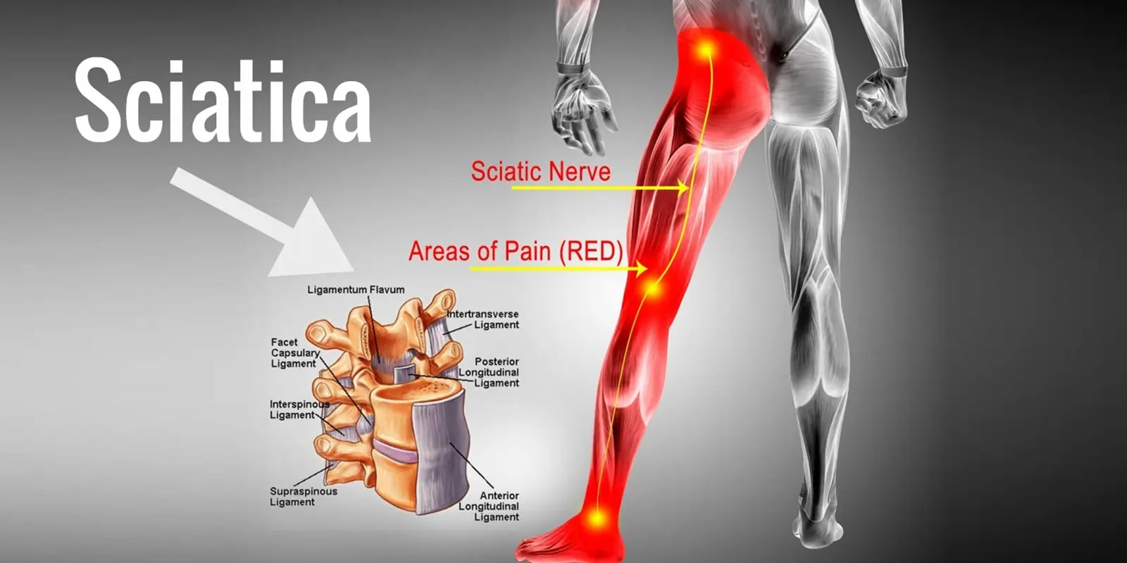 Acupuncture for sciatica condition