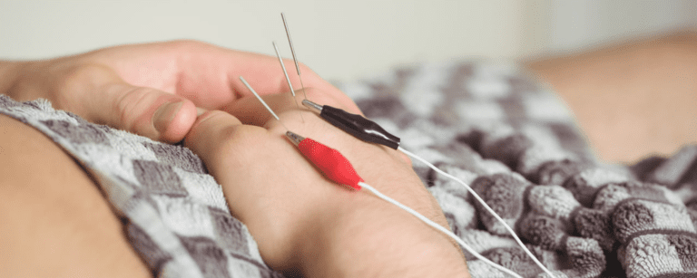 Benefits of Electroacupuncture