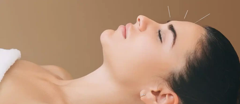 Acupuncture for Headaches