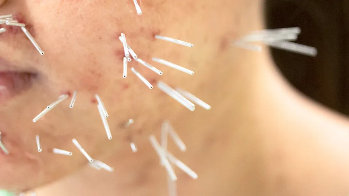 Acupuncture for Skin Conditions: Naturally Enhance Your Skin Health