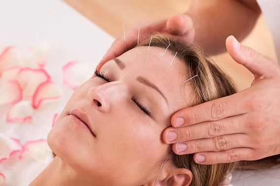 Can Acupuncture in Perth Help Support Stress and Anxiety Management