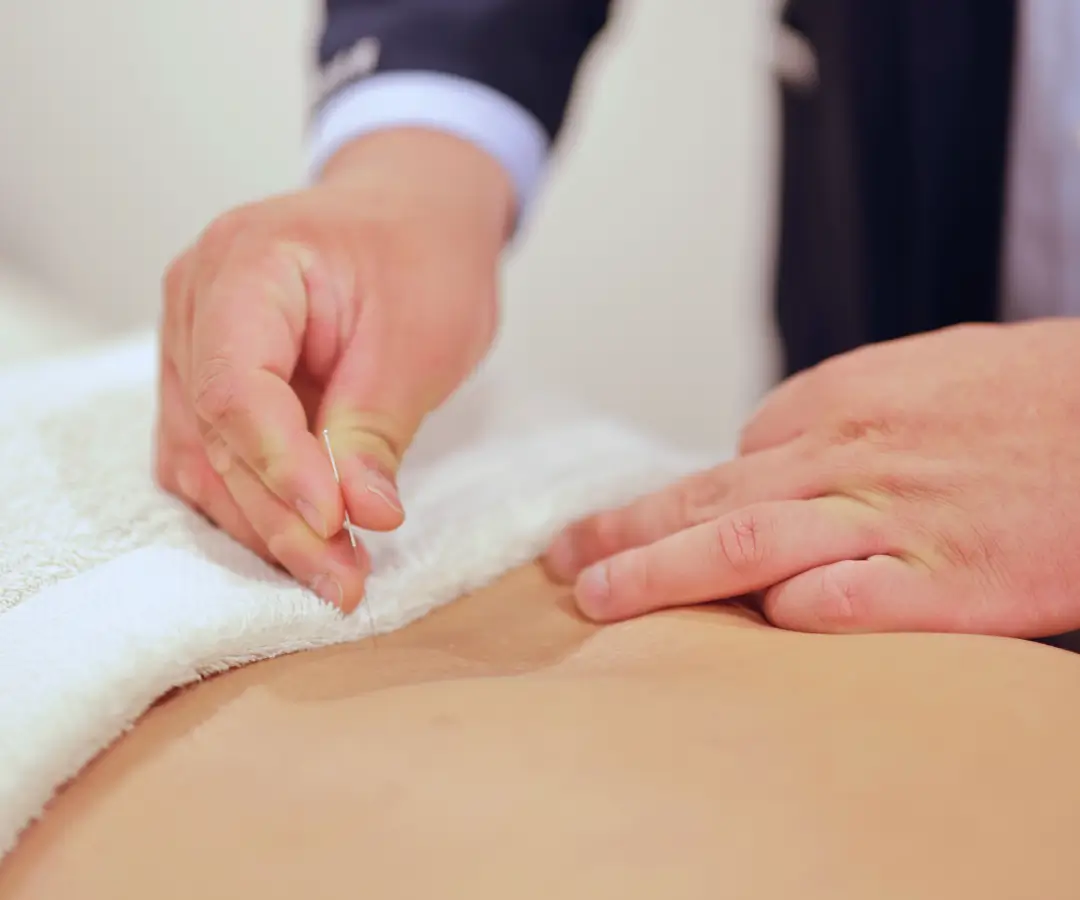 Acupuncture